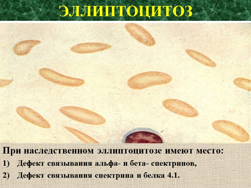 ЭЛЛИПТОЦИТОЗ При наследственном эллиптоцитозе имеют место: Дефект связывания альфа- и бета- спектринов, Дефект связывания